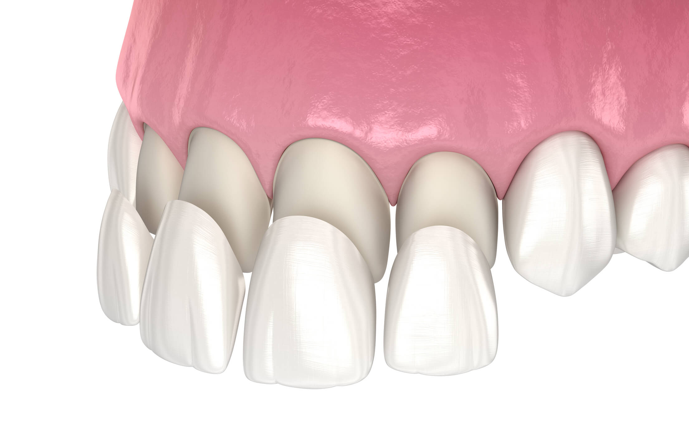 Full Set of Veneers and Crowns- Dental Clinic Turkey