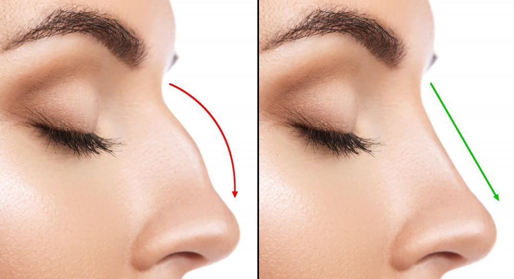 Top 15 Best Rhinoplasty (Nose Job) Doctors In Turkey – World