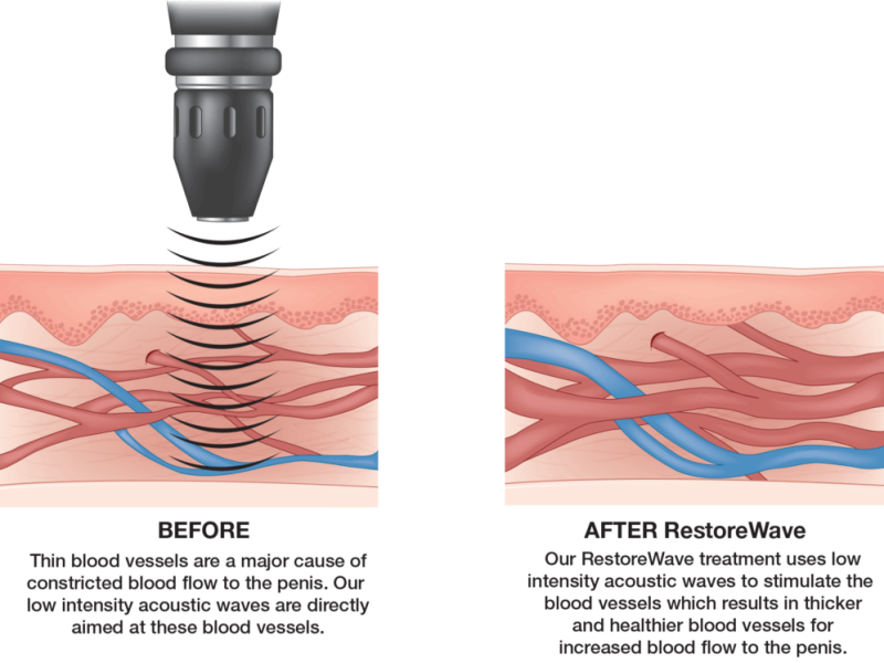 Penile Shock Wave Therapy